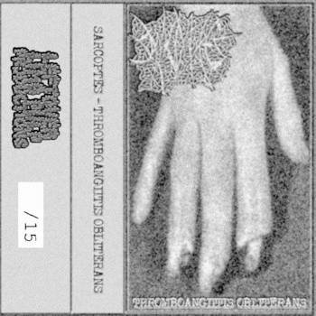 Sarcoptes (USA-1) : Thromboangiitis Obliterans